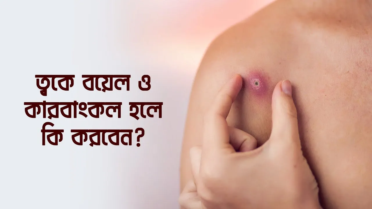 গরমকালে ত্বকে বয়েল ও কারবাংকল হলে কি করবেন?